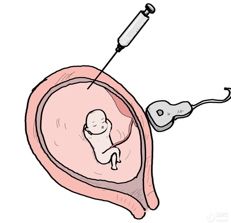 羊水穿刺，會損害到胎兒嗎？