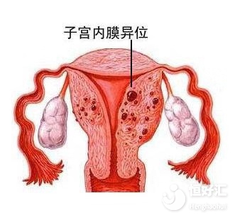 患有子宮內膜異位癥，會影響生育嗎？