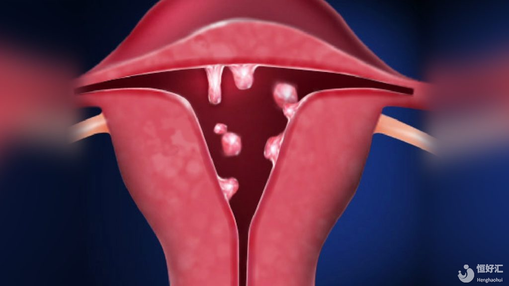 子宮息肉對試管嬰兒成功率的影響，別不重視！