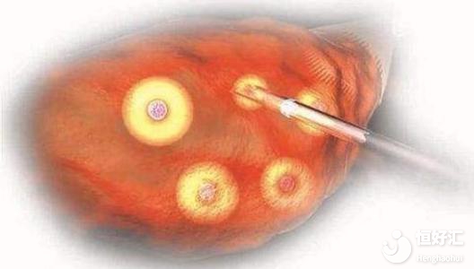 試管嬰兒取卵會(huì)影響女性健康？這些知識(shí)你得知道