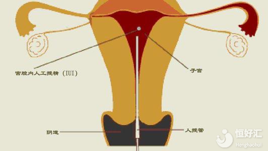 供精人工授精流程揭秘，你不知道的還有這幾點(diǎn)！