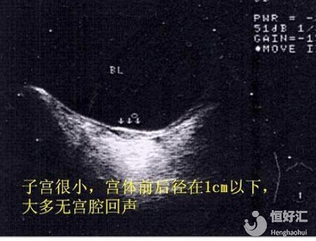 幼稚子宮能做試管嬰兒嗎？醫生提醒你這樣做