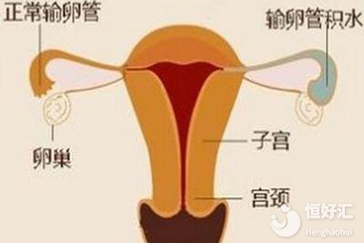 子宮異常不會影響試管嬰兒？請看完這個再下定論